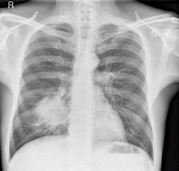 chest x-ray of lung cancer for man